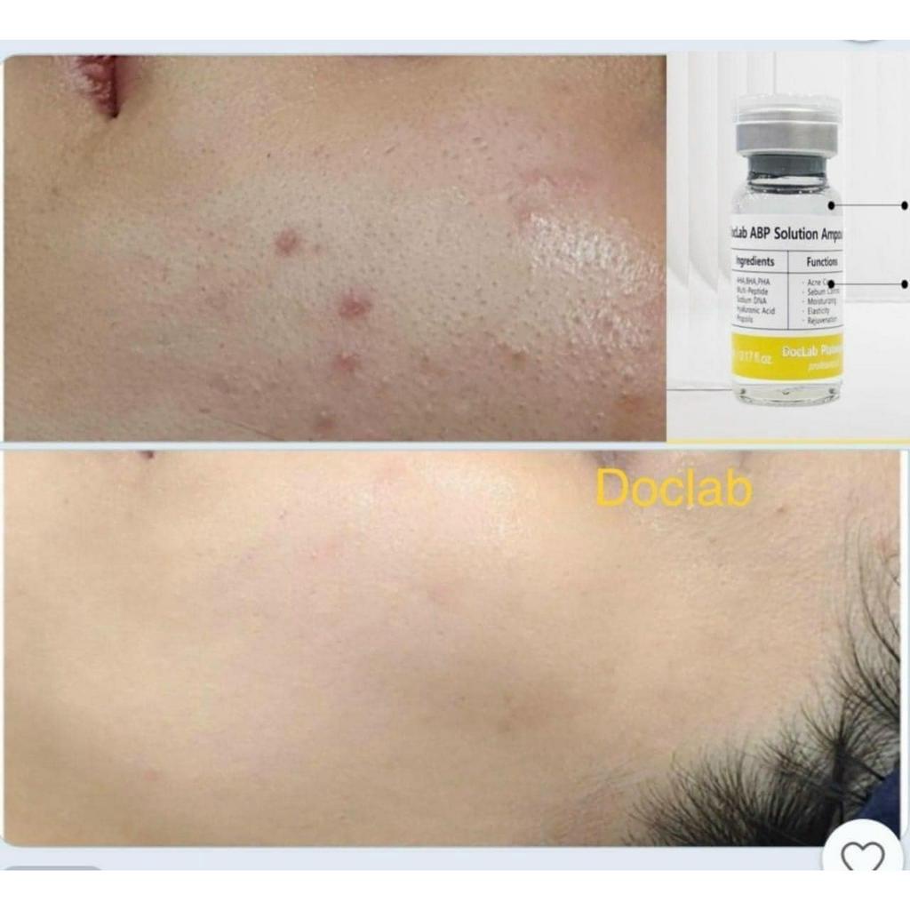 Tế bào gốc mụn DOCLAB 1 ống 5ml tách lẻ từ sét nguyên Hàn Quốc