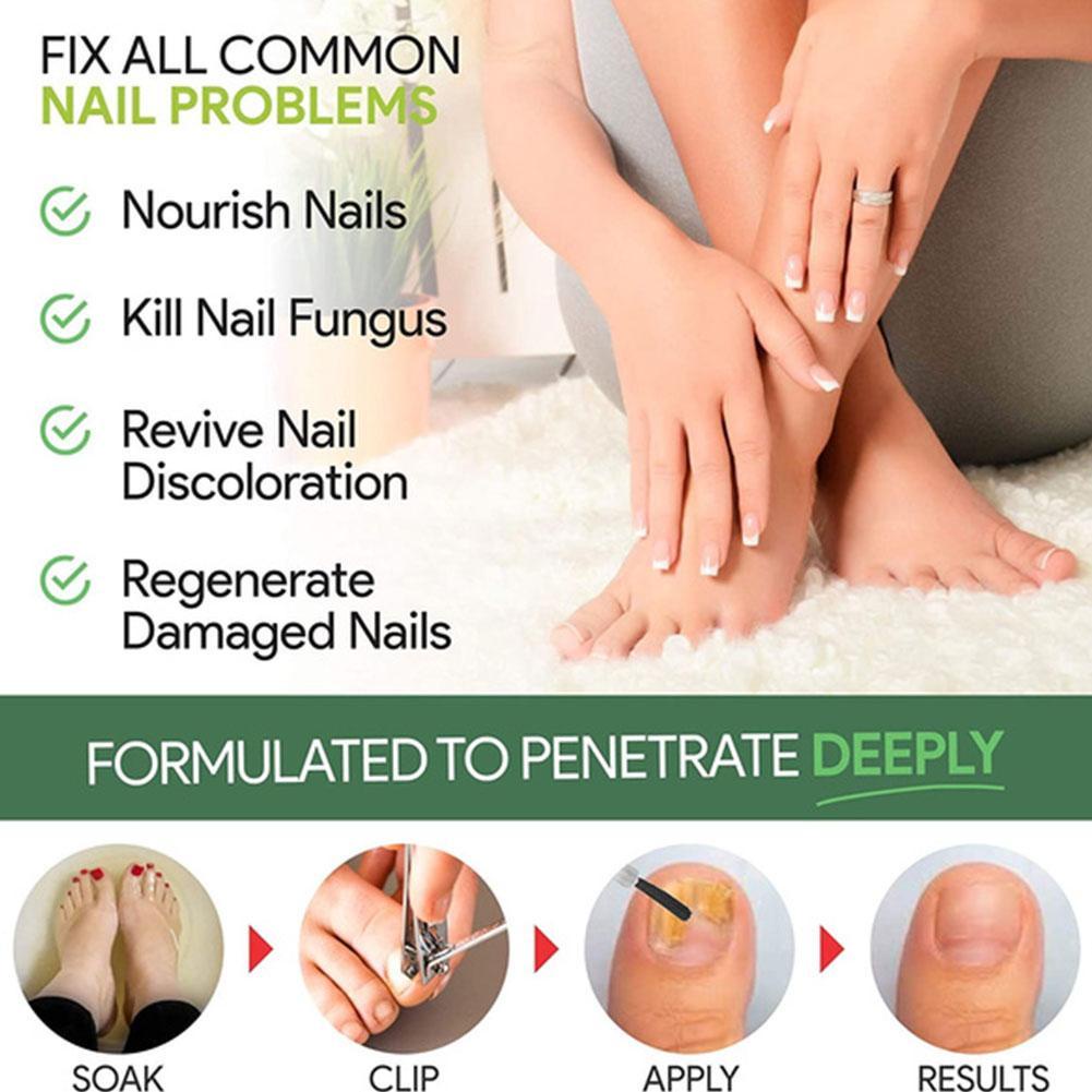 Dung Dịch Phục Hồi Móng Tay Và Chân Onychomyc T0B1 Chuyên Dụng Mới