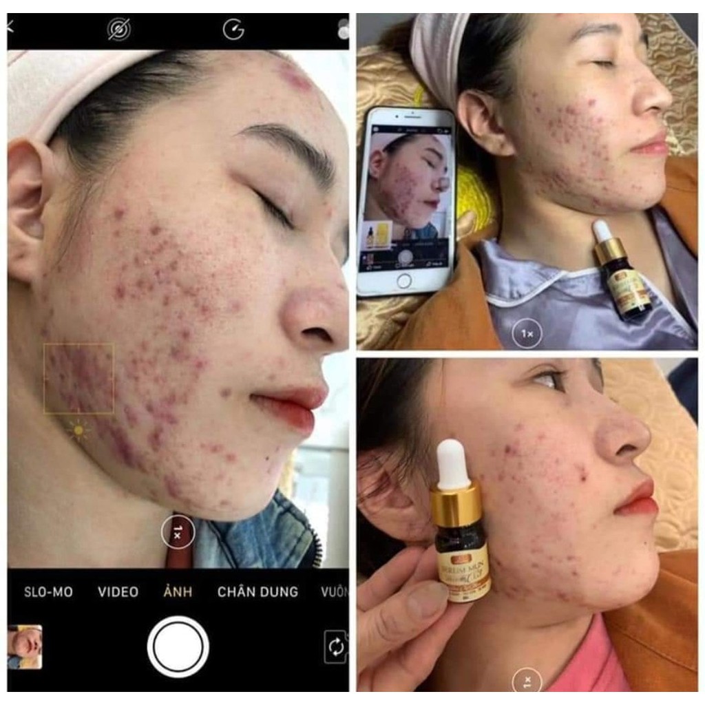 SERUM MỤN COLLAGEN X3 + KEM FACE COLLAGEN X3 MỸ PHẨM ĐÔNG ANH-COMBO DƯỠNG FACE HÓT(CHÍNH HÃNG)