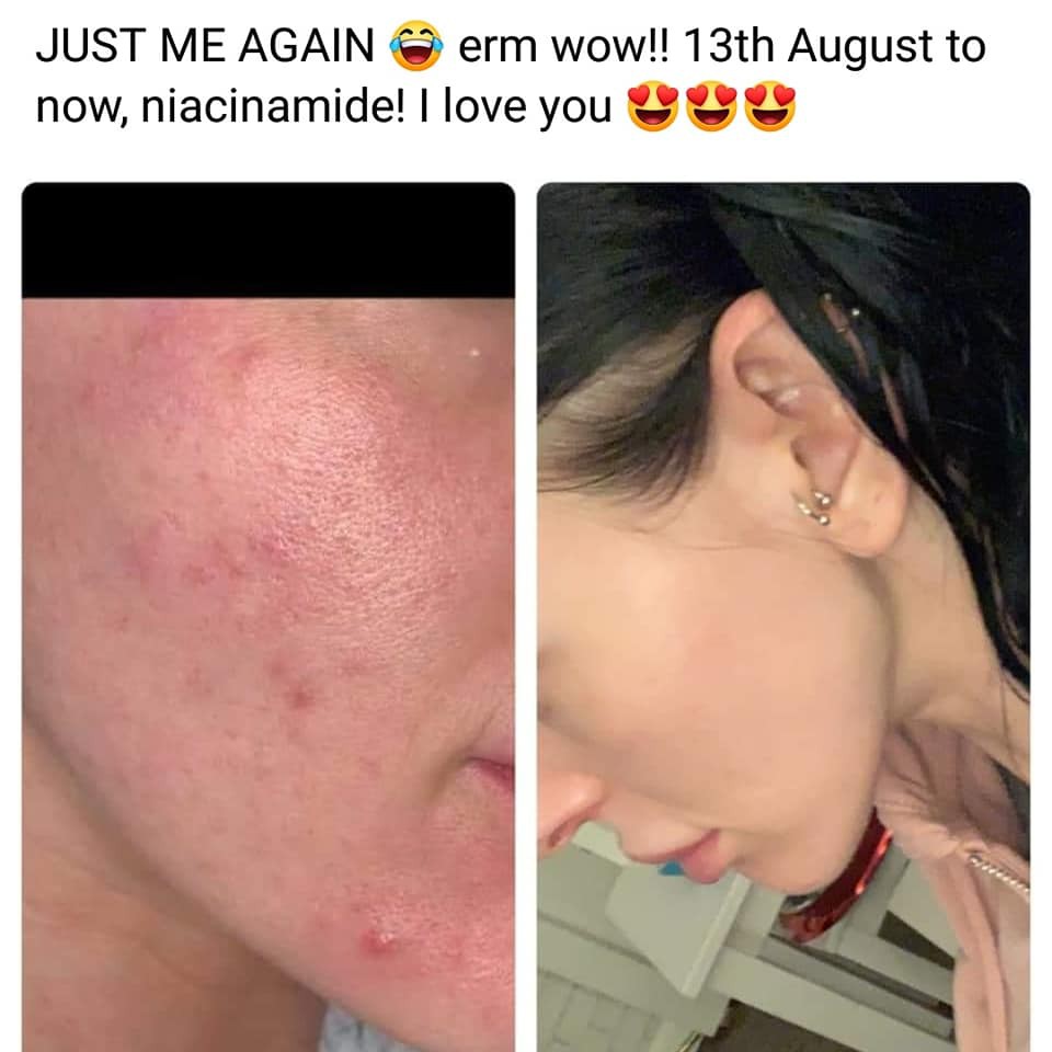 Serum giúp giảm mụn, sáng da se khít lỗ chân lông The ordinary Niacinamide 10% + ZinC 1%