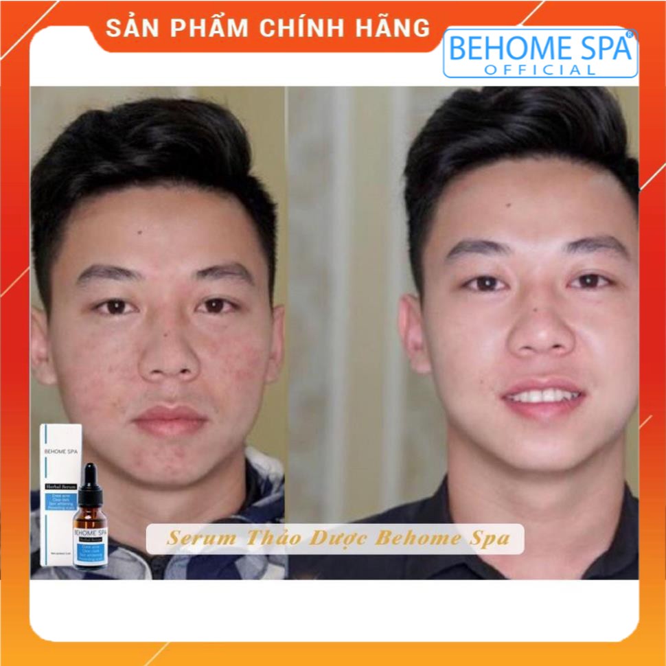 Serum mụn thảo dược Behome spa | BigBuy360 - bigbuy360.vn