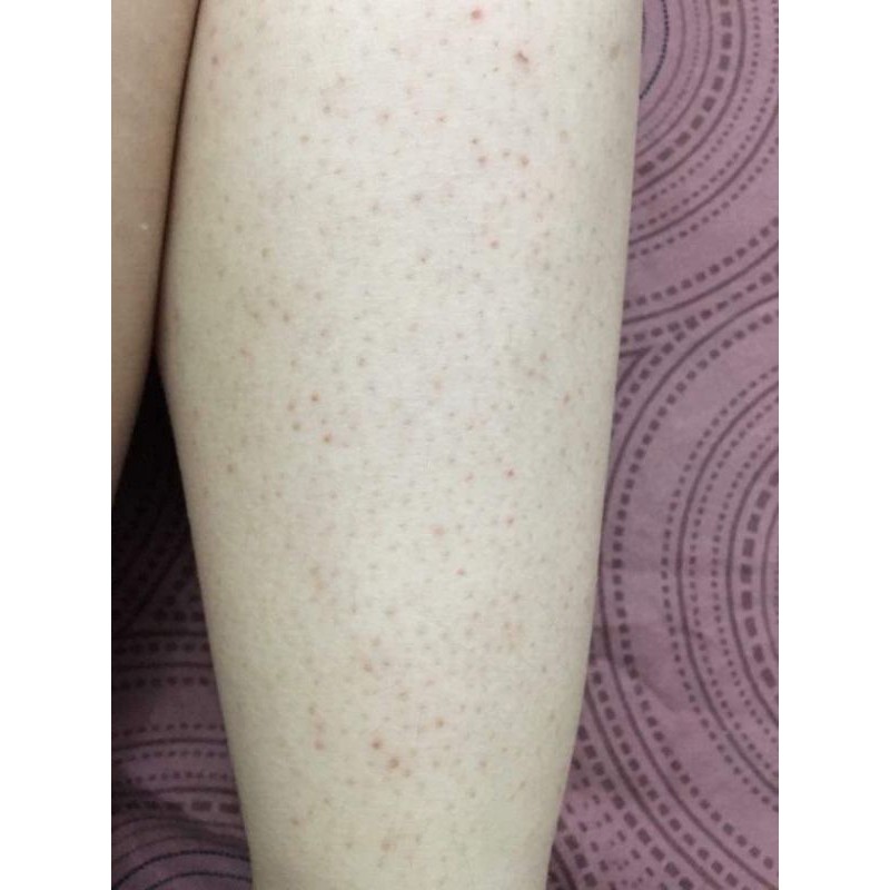 sỉ 5 viêm lỗ chân lông