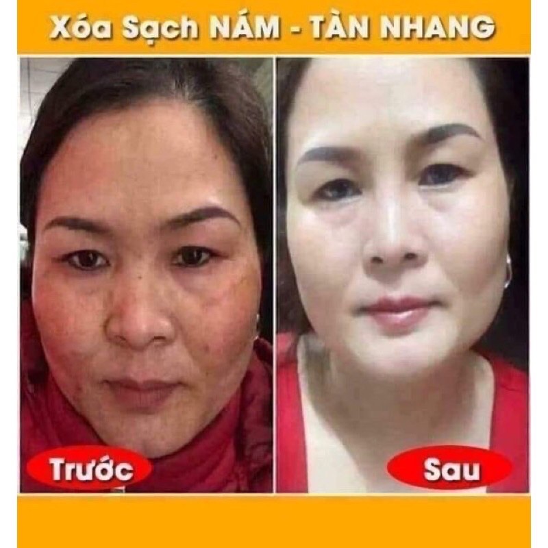 BỘ MỜ NÁM CLOBETAMIL C KÈM KEM DƯỠNG