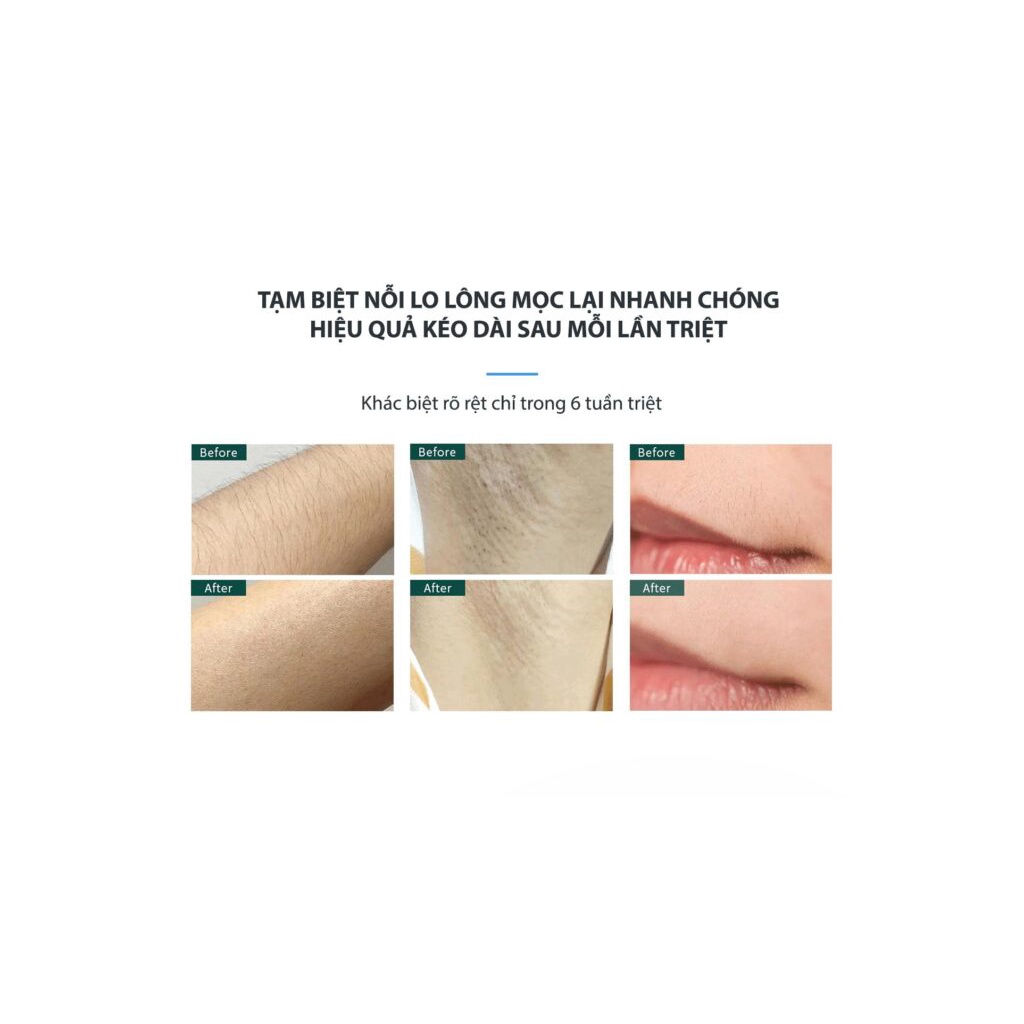 Máy triệt lông trẻ hoá da công nghệ IPL sapphire lạnh DIAMOND pin sạc NanoTime B65Pro Bảo hành 2 năm - Hàng Chính Hãng