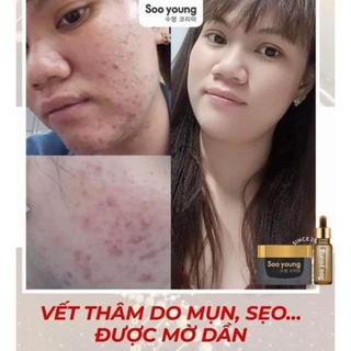 [Chín hãng] Combo kem face và serum mụn Soo Young
