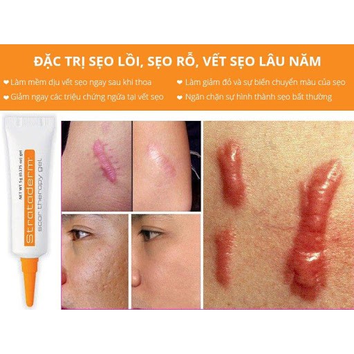 Kem Sẹo Strataderm [CHÍNH HÃNG] Strataderm 5g Thụy Sĩ - Gel ngừa sẹo xấu