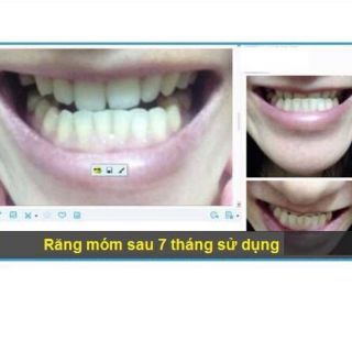 Niềng răng