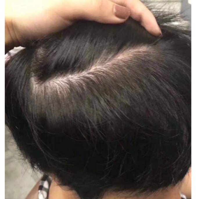 Dầu gội đen tóc, nâu tóc DL Collagen - phủ bac 100%, không dính da đầu