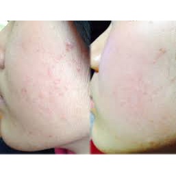 Lotion giảm mụn BIGANSUI MEISHOKU Nhật Bản | BigBuy360 - bigbuy360.vn