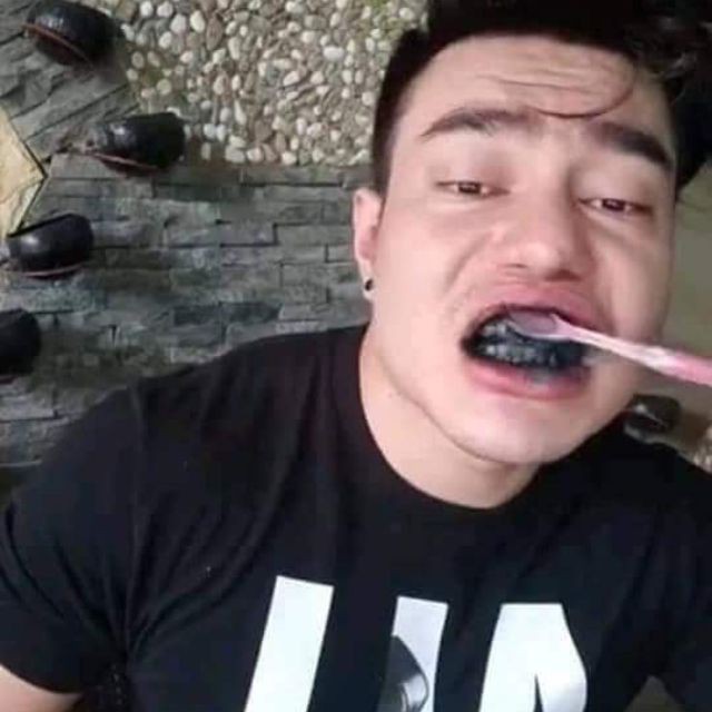 Kem đánh răng than hoạt tính GLORY SMILE trắng răng sau 1 tuần sử dụng