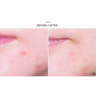 Miếng dán mụn Mayan Care