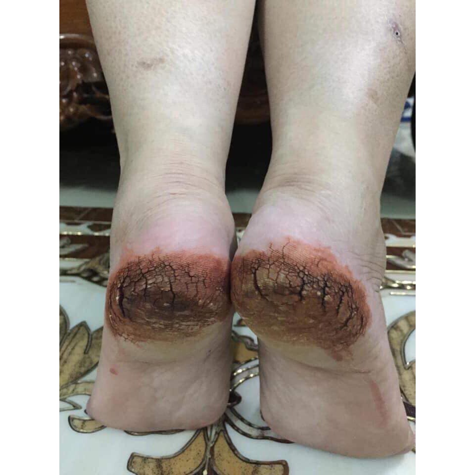 Bôi nứt gót chân bảo hành khỏi 100% | BigBuy360 - bigbuy360.vn