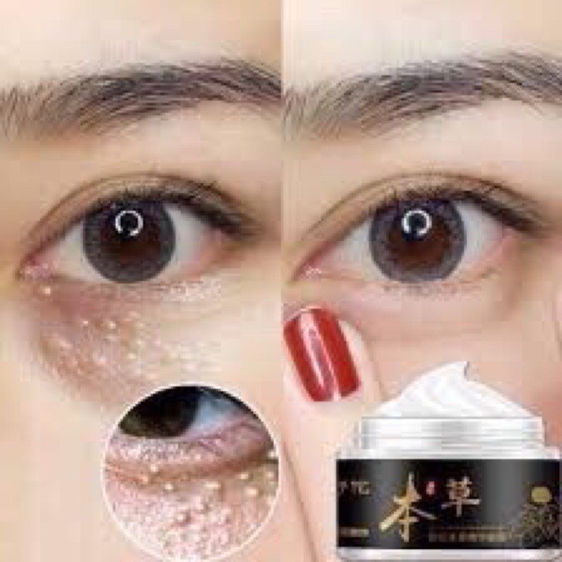 Kem mụn thịt đông y