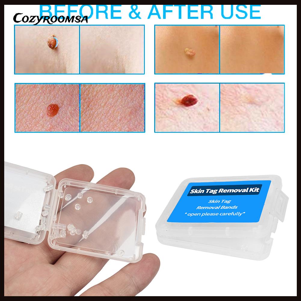 Bộ 30 Miếng Dán Loại Bỏ Thịt Thừa Trên Da Tiện Dụng