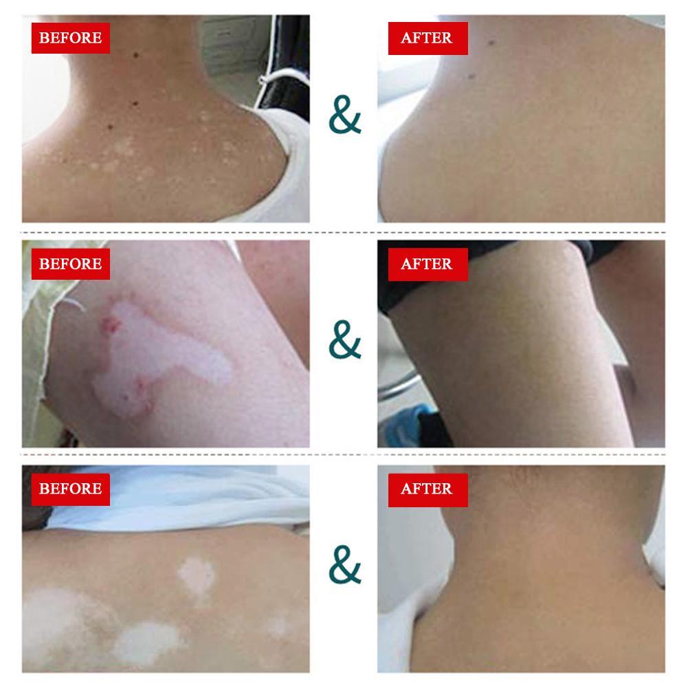 Kem dưỡng trắng da cao cấp Vitiligo 30g