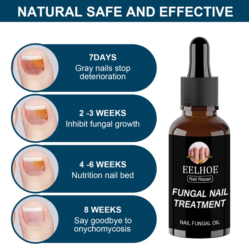 Eelhoe Dung Dịch Điều Trị Nấm Móng Dạng Lỏng Sửa Chữa 30Ml/50Ml Metro