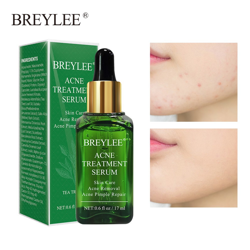 （Quà tặng miễn phí ）Breylee Serum mụn Anti Acne làm sạch và cải thiện tổn thương do mụn 17ml