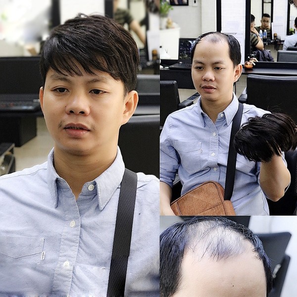 Tóc mái hói–Tóc thật dệt trên nền lưới ren ở giữa kết hợp viền Poly siêu mỏng bao quanh-MSP:Bp771-SL: 1 Mũ