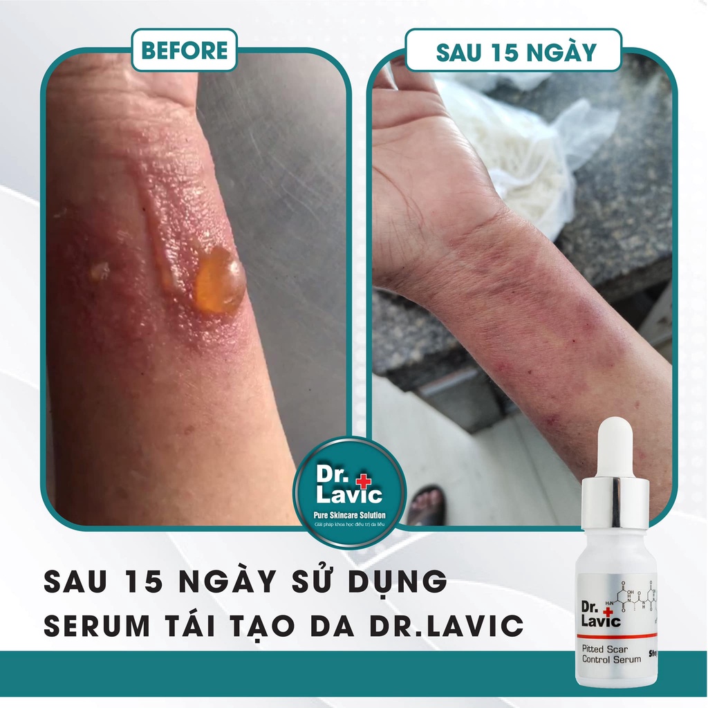 Serum tái tạo da SỐ 3 DR.LAVIC, làm mờ thâm, tinh chất trắng da Công Nghệ USA - Pitted Scar Control Serum Step 3 -10ml