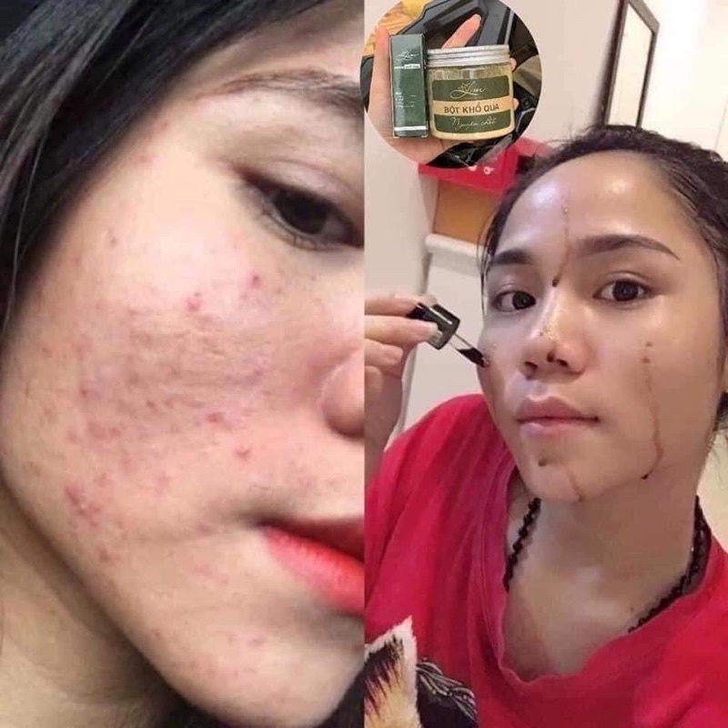 Combo serum bột khổ qua mướp đắng Lim sạch mụn mờ thâm nám an toàn hiệu quả | BigBuy360 - bigbuy360.vn