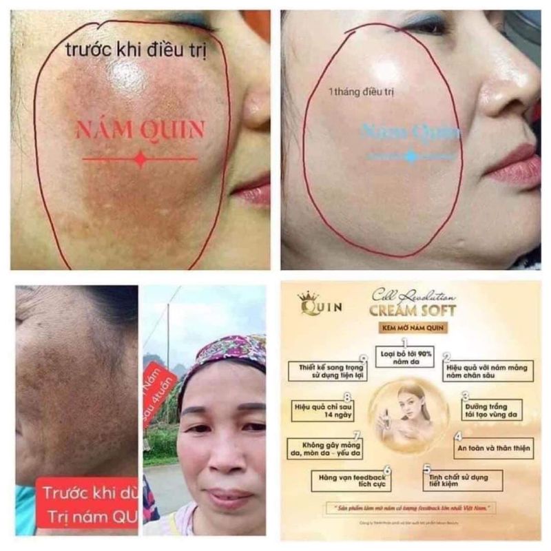 Kem mờ nám quin | BigBuy360 - bigbuy360.vn
