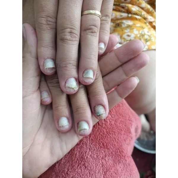 Điều trị nấm móng Varisi