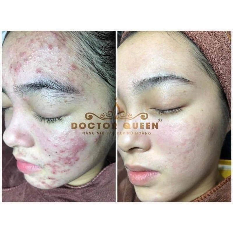 Detox mụn doctor queen