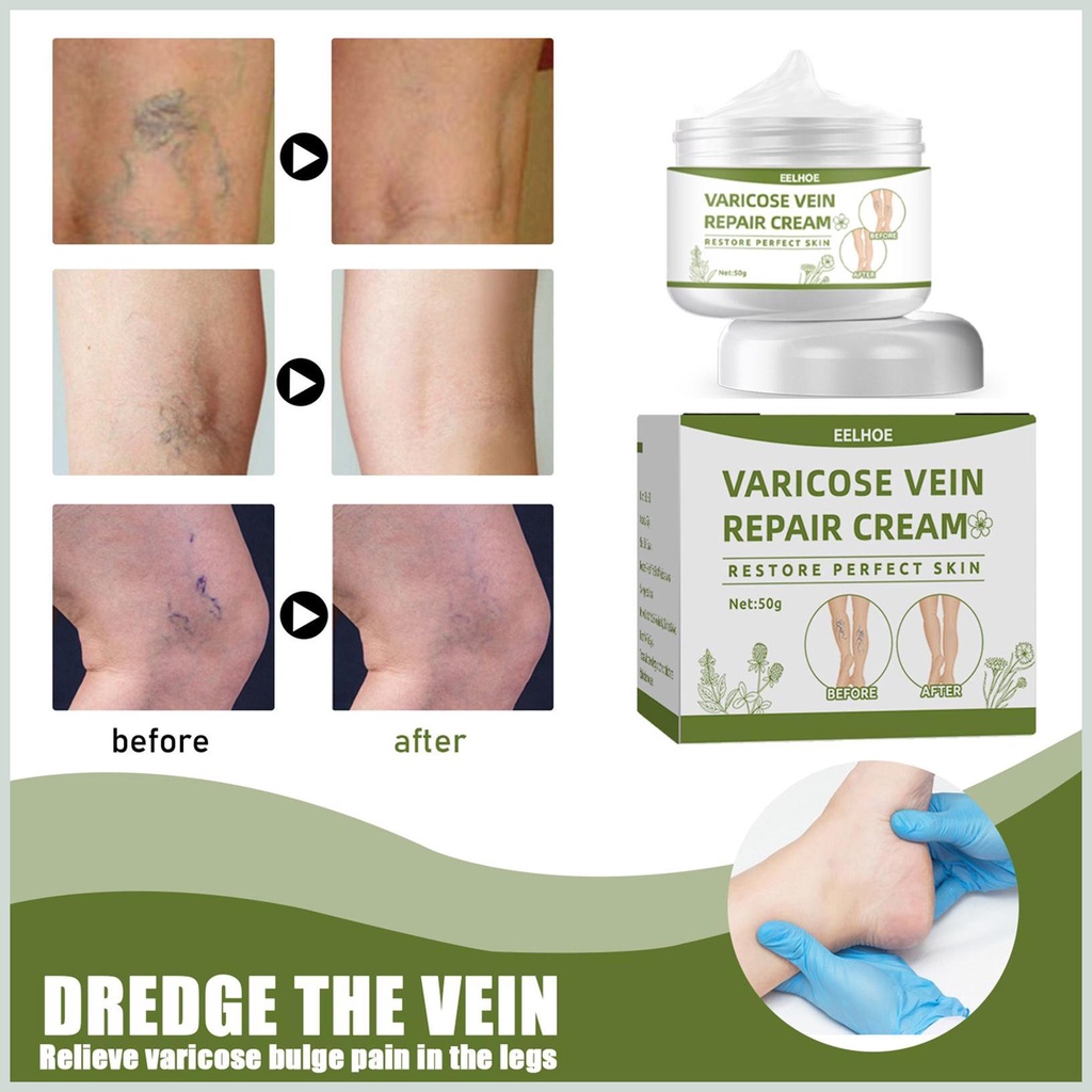 Kem Suy Giãn Tĩnh Mạch Perfect Skin 50g - Kem Varicose Vein Repair Cream Restore Thảo Dược Cải Thiện Tĩnh Mạch