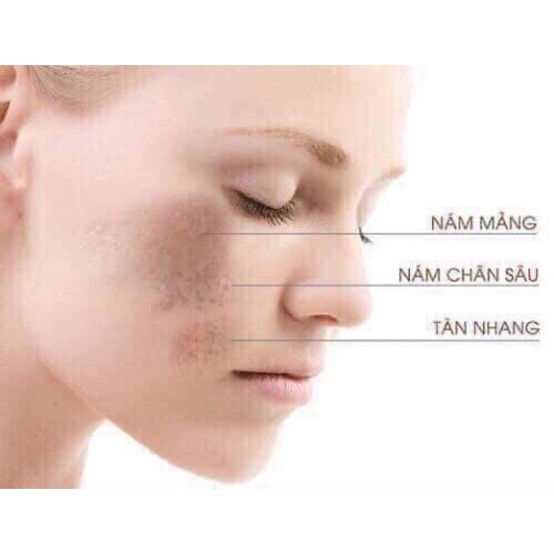 10 vỉ date 2025 - Cao nám dạng kem đặc khô ráo dưỡng sáng da giảm sạm nám