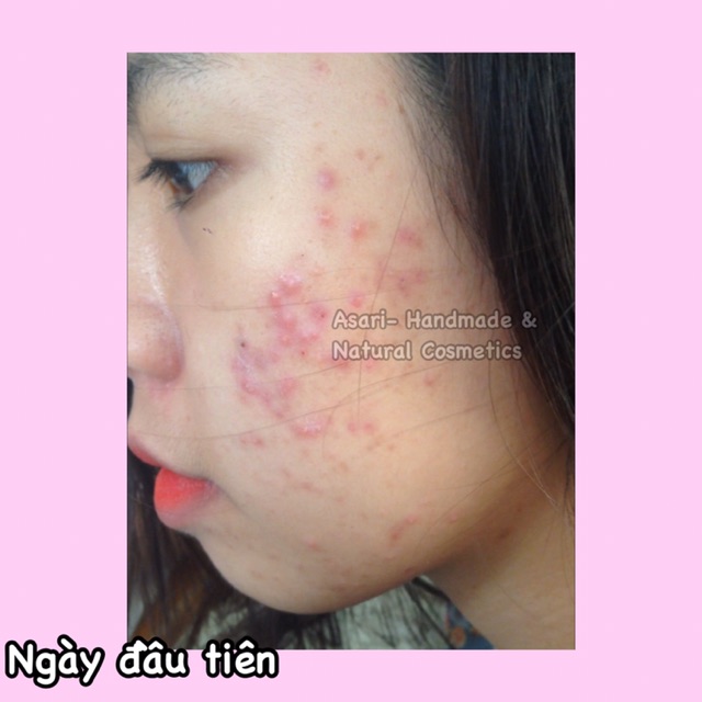 Toner trị mụn chiết xuất cây liễu trắng Handmade | BigBuy360 - bigbuy360.vn