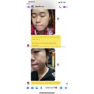 COMBO CAO MỤN, CỐT HUYẾT THANH VER2