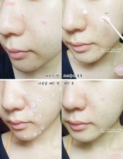 Chấm mụn bye bye blemish