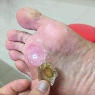 TẨY BONG MỤN CÓC NGA