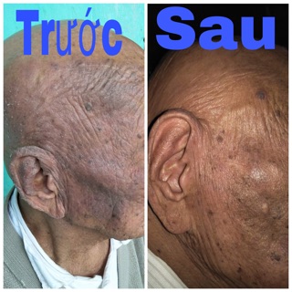 Thuốc bôi trị á sừng của Đức Glysolid