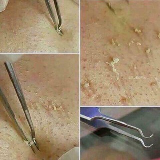 Nhíp Gắp Mụn Thần Thánh Thái Lan