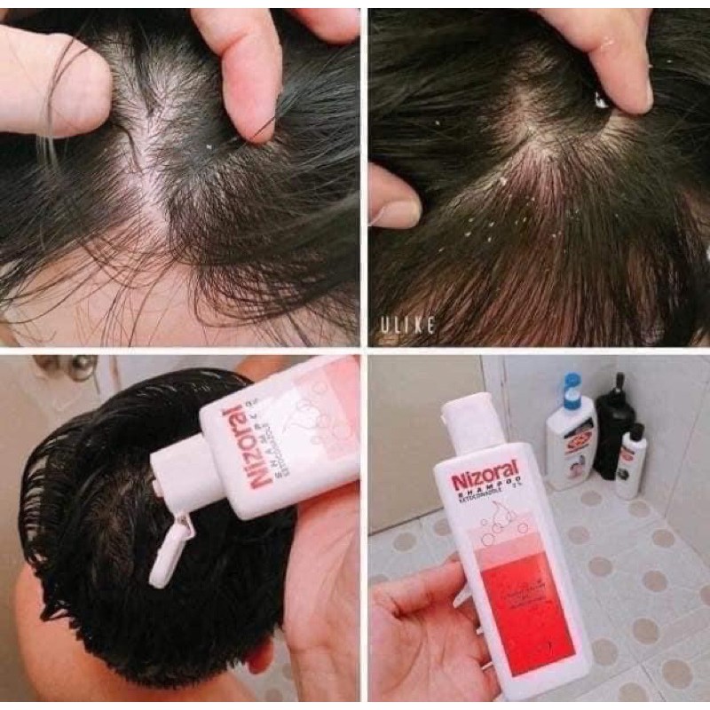 [CHỈ BÁN HÀNG THÁI] DẦU GỘI NẤM DA ĐẦU,GÀU THÁI LAN[SẴN][FREESHIP][CHUẨN HÀNG][BẢO HÀNH 7 NGÀY] | BigBuy360 - bigbuy360.vn