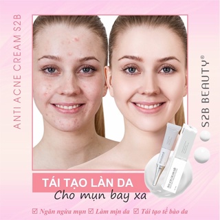 KEM NGỪA MỤN S2B BEAUTY