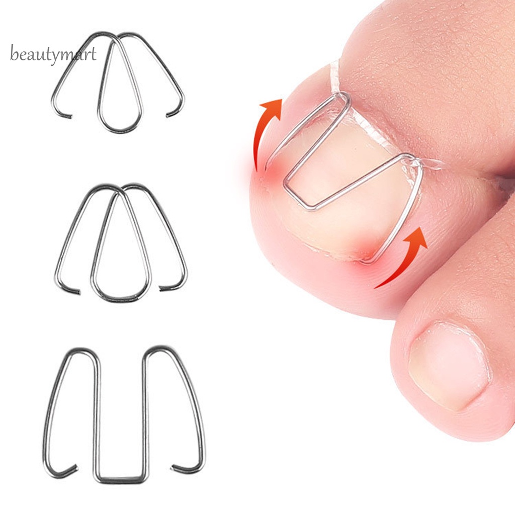 [Hàng mới về] Dụng cụ hỗ trợ điều chỉnh móng chân mọc ngược dễ dàng