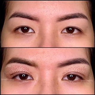 Máy nhấn mí Plasma XÓA MỤN LỐT RUỒI