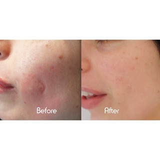 KEM ĐẨY MỤN ẨN RETIN - A (TRETINOIN)