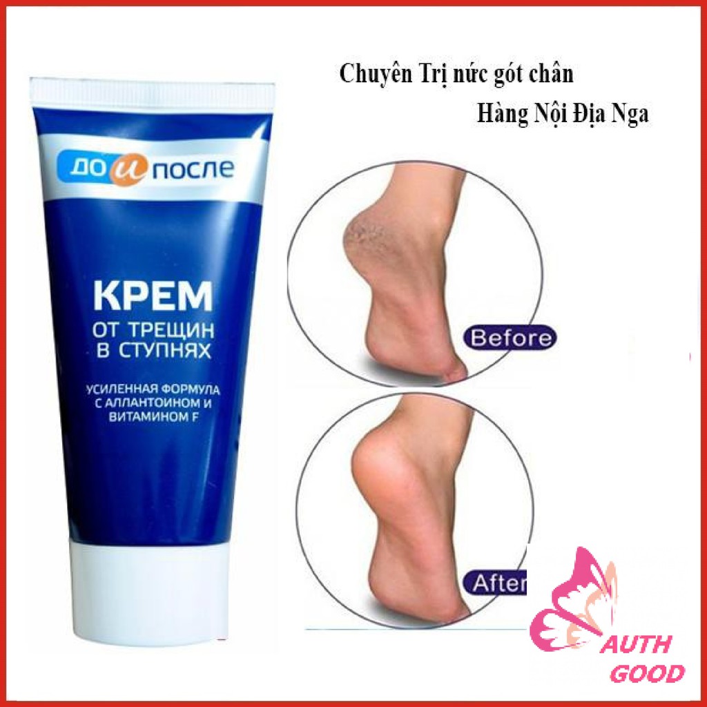 Kem dưỡng FREESHIP Kem giảm nứt gót chân Kpem Nga