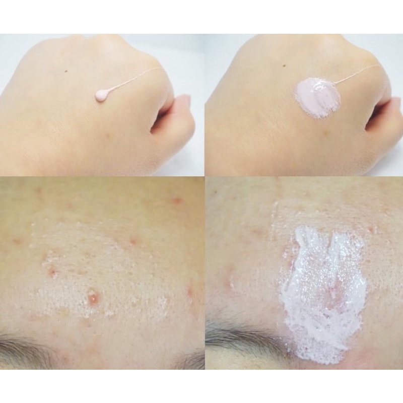 Kem Dưỡng Giảm Mụn Viêm, Mụn Sưng Mủ, Mờ Thâm, Mờ Sẹo, Giảm Mụn Ẩn G9Skin Calamine Gel Spot Patch LOVESKINCARE VN