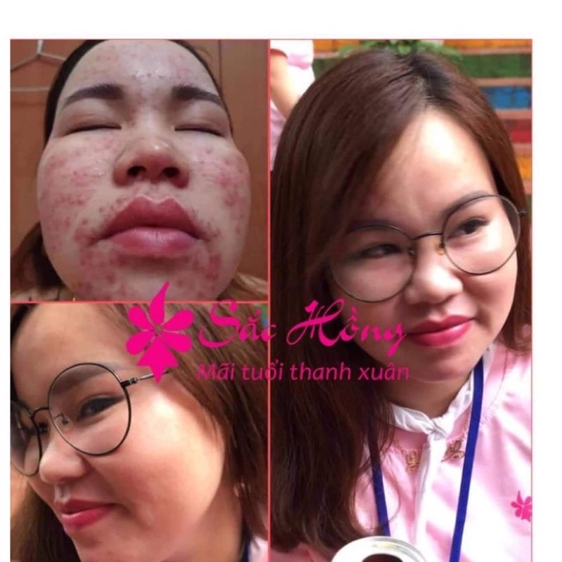 TINH CHẤT NGỪA MỤN NÁM SẮC HỒNG