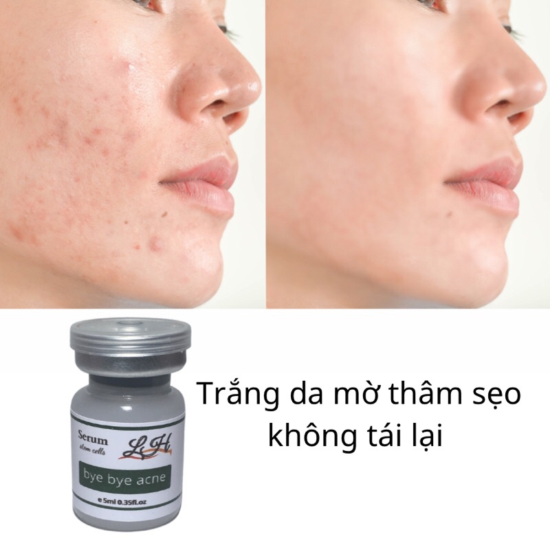 Serum giảm mụn thâm rỗ L&H  - Skin 7 Days - Công dụng 5 trong 1 hiệu quả sau 7 ngày, tạm biệt mụn