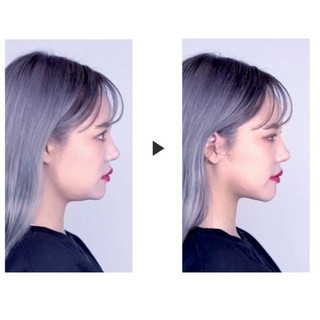Miếng dán mặt VLine hộp 40 miếng