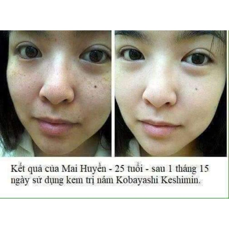 Kem Dưỡng Mờ Nám Kobayashi Ex Premium Nhật Bản