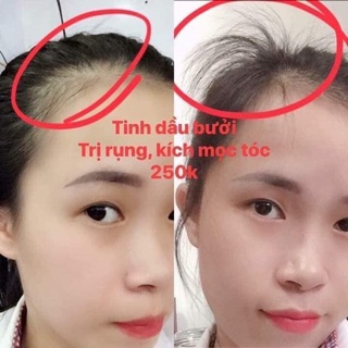 TINH DẦU BƯỞI TRỊ RỤNG TÓC