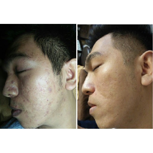 Cải Thiện tận gốc mụn, nám rỗ, tàn nhan với Tái Tạo Nhanh Sắc Dược Thiên