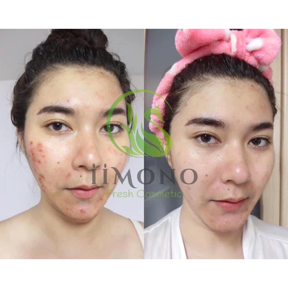 Tinh chất mụn IIMONO 6ml | BigBuy360 - bigbuy360.vn