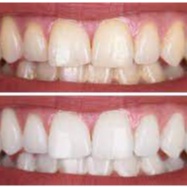 Miếng dán trắng răng 3D White teeth trắng răng sau 7 ngày